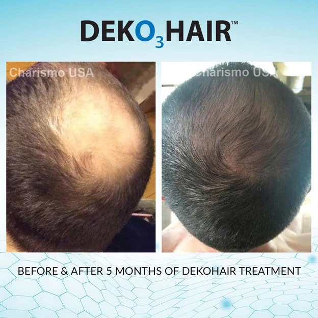 DEKOHAIR 6-Month Bundle - Image 4